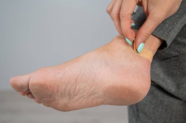 Bir kadın bacağına alçıyla mısır yapıştırıyor. Kız rahatsız edici ayakkabılarla bacağını ovuşturdu..