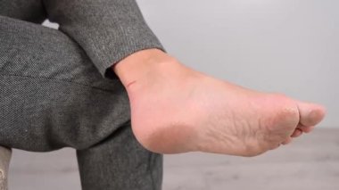 Bir kadın bacağına alçıyla mısır yapıştırıyor. Kız rahatsız edici ayakkabılarla bacağını ovuşturdu..