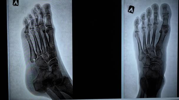 Lekarz wskazuje na złamanie piątej kości śródstopia na rentgenie.. — Wideo stockowe