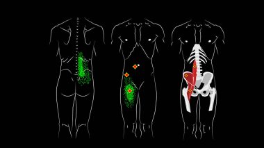 Trigger points and reflected pain in psoas major muscle, psoas minor muscle and in Iliacus muscle. Illustration on black background clipart
