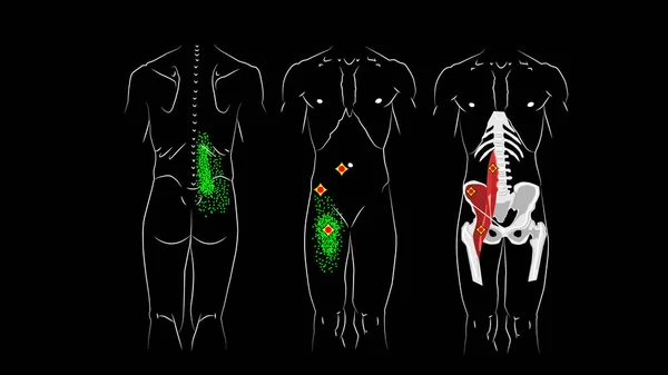 Triggerpunkte Und Reflektierte Schmerzen Psoas Major Muskel Psoas Minor Muskel — Stockfoto