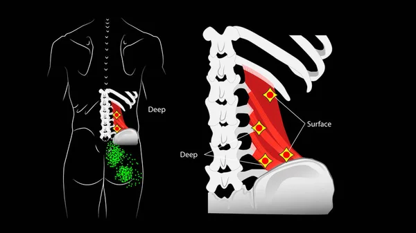 Глубокий и поверхностный триггер в поясничной мышце и отражающая боль. — стоковое фото
