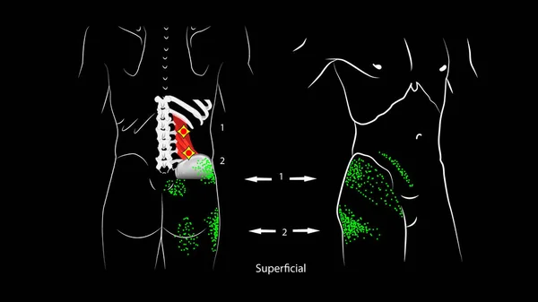 Anatomie, diepe en oppervlakkige triggerpunten in de quadratus lumbale spier en gereflecteerde pijn. — Stockfoto