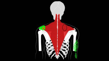 Trigger points and reflected pain in the trapezius. clipart