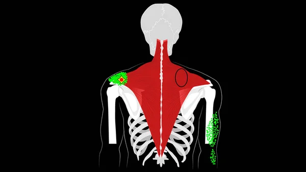 Trigger points and reflected pain in the trapezius. — Stock Photo, Image