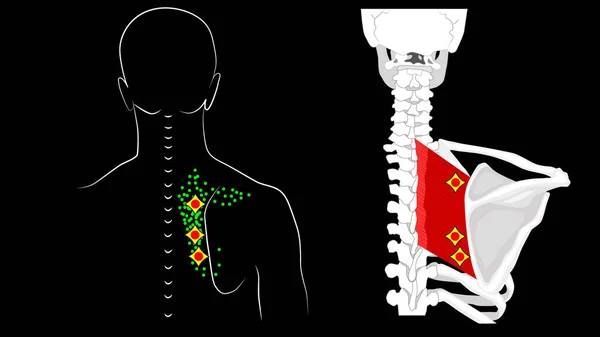 Triggerpunkte in rautenförmigen Haupt- und rautenförmigen Nebenmuskeln. Anatomie. Spiegelnde Schmerzen in der Rückenmuskulatur. — Stockfoto