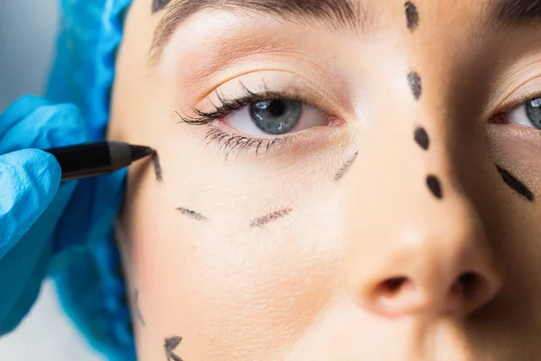 Patient avec des lignes pointillées sur le visage — Photo