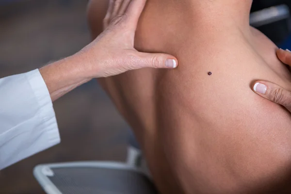 Dermatologista examinando a toupeira do paciente — Fotografia de Stock