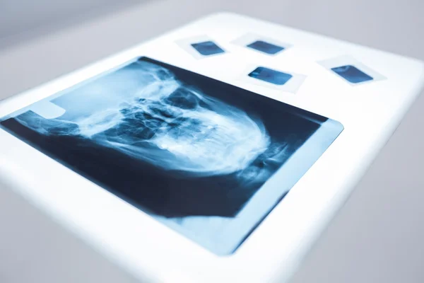 Fechar de um raio-X de um crânio humano na mesa — Fotografia de Stock