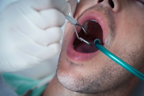 Close-up de homem ter seus dentes examinados — Fotografia de Stock