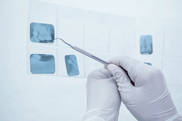 Luva mão segurando ferramenta dentária aos dentes raio-x — Fotografia de Stock