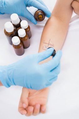 Doctor doing skin prick test at patient clipart