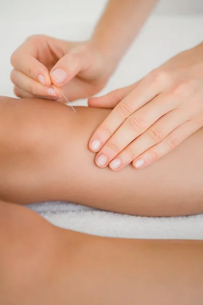 Mujer sosteniendo la aguja en una terapia de acupuntura — Foto de Stock