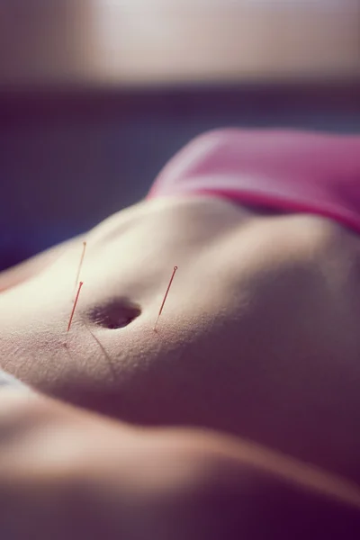 Młoda kobieta coraz leczenie akupunktura — Zdjęcie stockowe