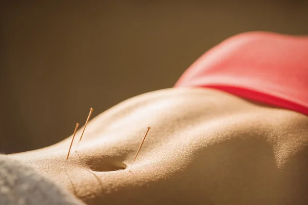 Giovane donna ottenere il trattamento di agopuntura — Foto Stock
