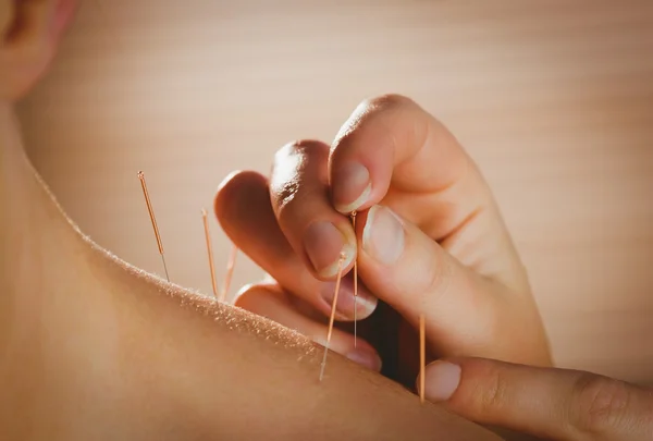 Jovem mulher recebendo tratamento de acupuntura — Fotografia de Stock