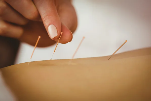 Jonge vrouw krijgen acupunctuur behandeling — Stockfoto