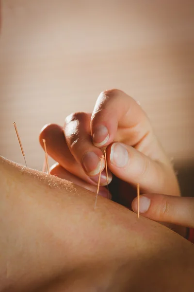 Mulher recebendo tratamento de acupuntura — Fotografia de Stock