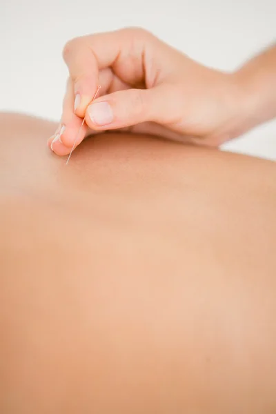 Kvinna anläggning nål i en akupunktur terapi — Stockfoto