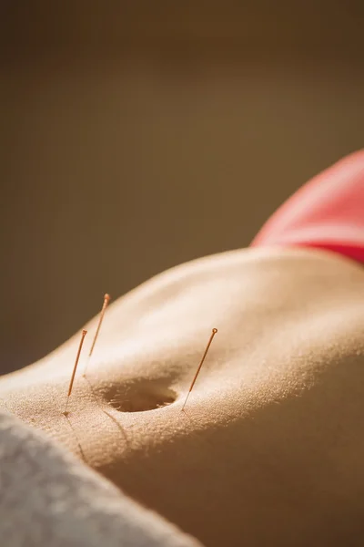 Junge Frau erhält Akupunktur-Behandlung — Stockfoto