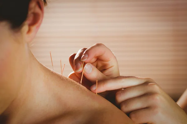 Jovem mulher recebendo tratamento de acupuntura — Fotografia de Stock