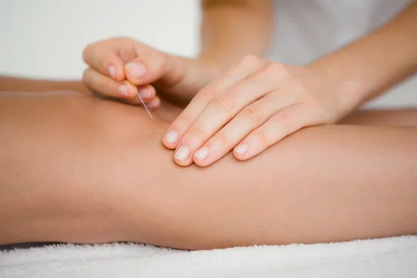 Mulher segurando agulha em uma terapia de acupuntura — Fotografia de Stock