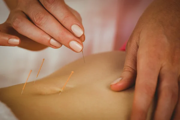Jovem mulher recebendo tratamento de acupuntura — Fotografia de Stock