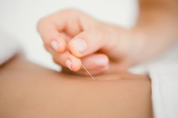 Mulher segurando agulha em uma terapia de acupuntura — Fotografia de Stock