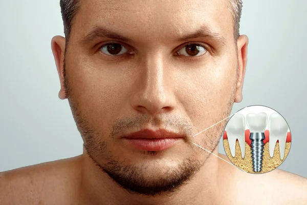 Ett Porträtt Man Som Avbildar Ett Tandimplantat Käken Tandvård Koncept — Stockfoto