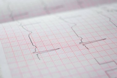 Özel kağıda kalp elektrokardiyogramı EKG grafiği. Kalp taraması, sağlık sigortası, tıbbi geçmiş, muayene