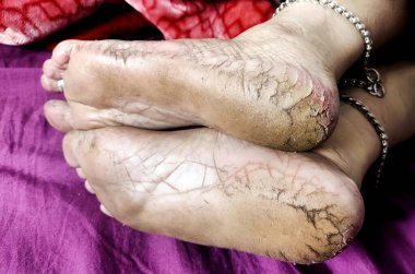 Yüksek çözünürlüklü yakın çekim görüntüsü kuru, çatlak topuklar ve çıplak ayak tabanları, cilt dokusu ve ayak bakımı sorunları vurgulanıyor.