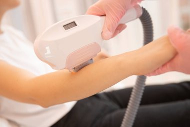 Genç bir kadının elindeki koyu renk saçların lazerle temizlenmesi. Epilasyon Cilt Bakımı