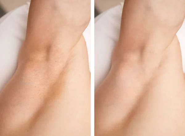 Before and after hair removal procedure from men armpit, laser epilation studio