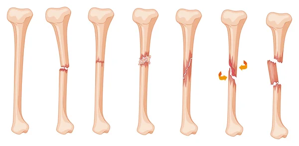 Diagram of leg fracture in different stages — Stock Vector
