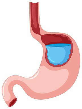 Gastroesophageal Reflux Disease with liquid in stomach clipart