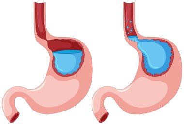 Diagram of Gastroesophageal Reflux Disease clipart