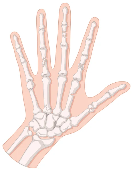Diagramme rapproché de la fracture de la main — Image vectorielle