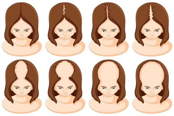 Etapas de perda de cabelo na mulher —  Vetores de Stock