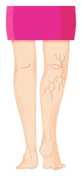 Venas varicosas en las piernas humanas — Vector de stock