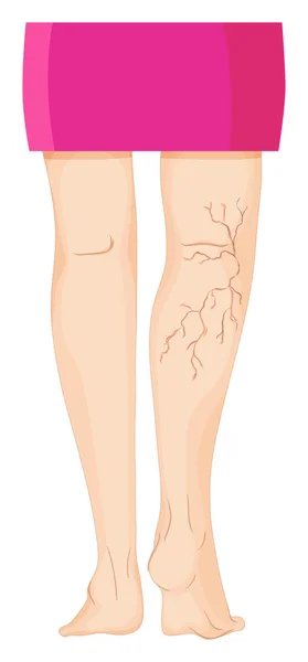 Varizes nas pernas humanas — Vetor de Stock