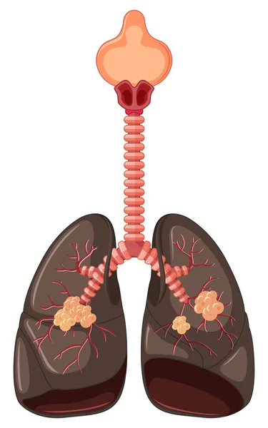 Diagrama del cáncer de pulmón — Archivo Imágenes Vectoriales
