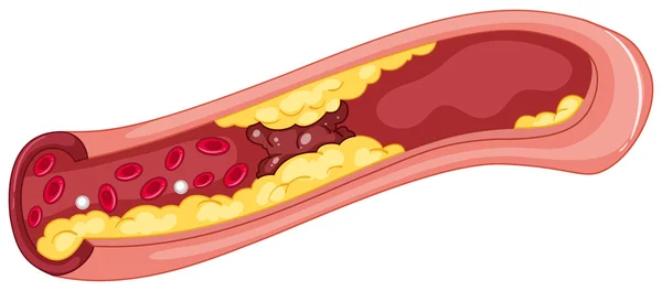 Imagen de cerca del coágulo de sangre — Vector de stock