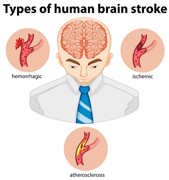 Tipos de accidente cerebrovascular humano — Vector de stock