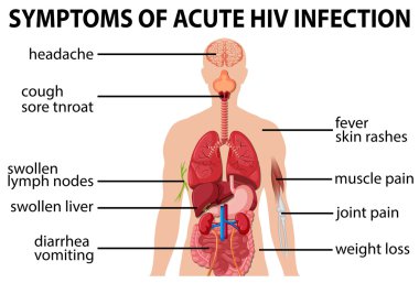 Hesap planını akut HIV enfeksiyonu belirtileri