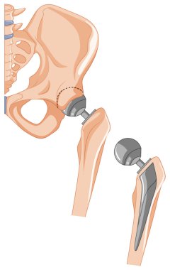 Kalça kemiği tedavi şeması