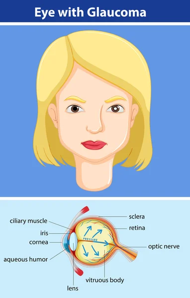 Diagrama que muestra el ojo con glaucoma — Vector de stock