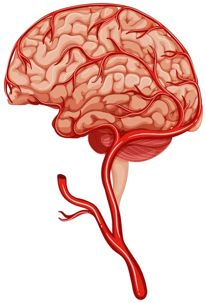 Caillot sanguin dans le cerveau humain — Image vectorielle