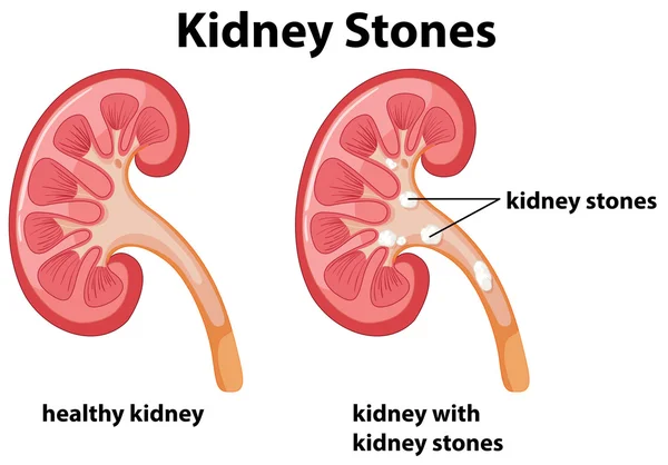 Diagram of kidney stones — Stock Vector