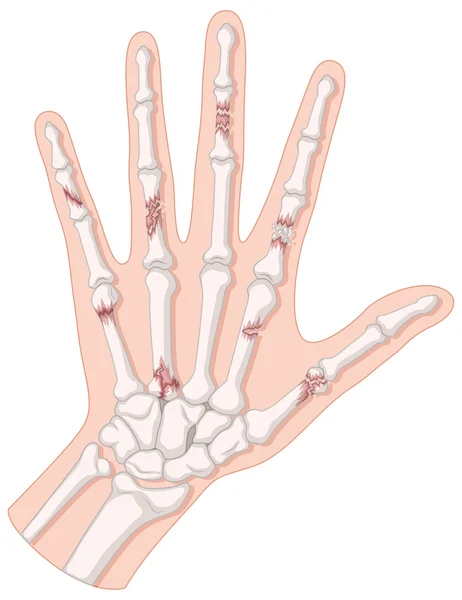 Huesos rotos en la mano humana — Vector de stock