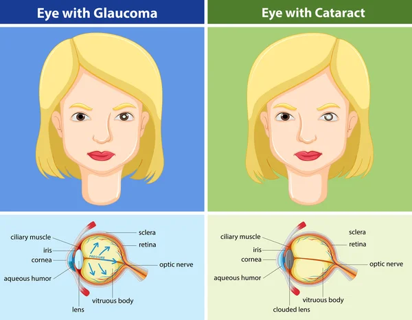 Comparison chart of eyes with and without glaucoma — Stock Vector